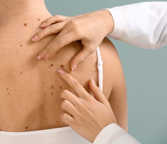 Удаление родинок: полезные рекомендации для жителей Винницы